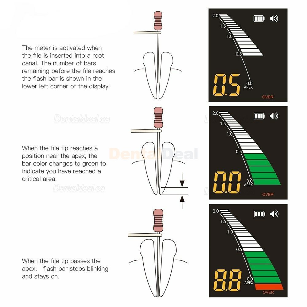 Westcode Mini Dental Endodontic Apex Locator Apex Finder